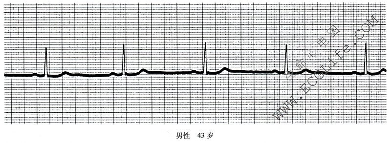 窦性心动过缓- 心电图学- 天山医学院