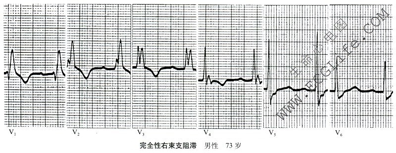 完全性右束支阻滞心电图（导联2）