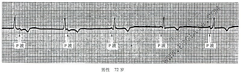 房室脱节心电图