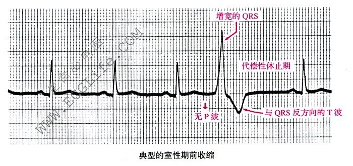 室性期前收缩的心电图特点