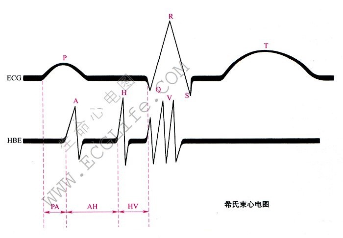 希氏束心电图（HBE）