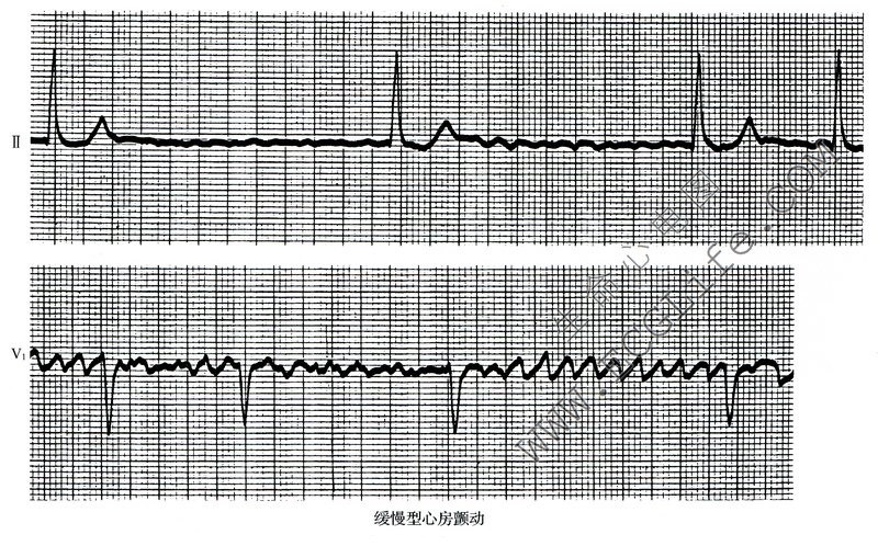 缓慢型心房颤动（心电图表现）