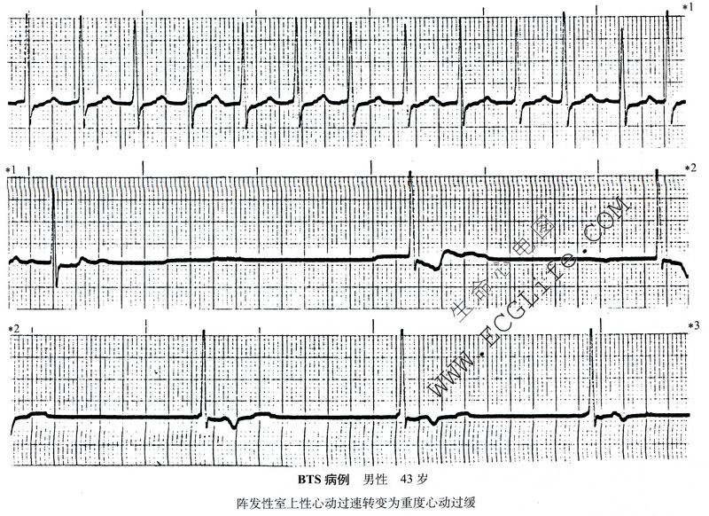 阵发性室上性心动过缓转变为重度心动过缓（心电图）
