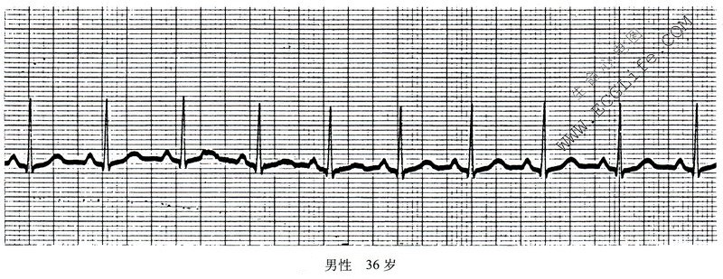 窦性心动过速心电图