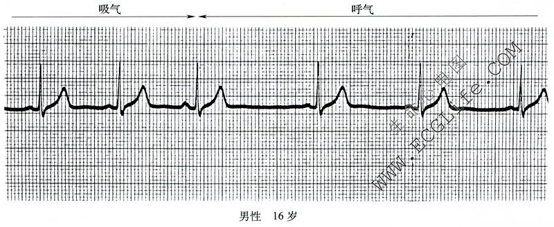 窦性心律不齐心电图（吸气、呼气）