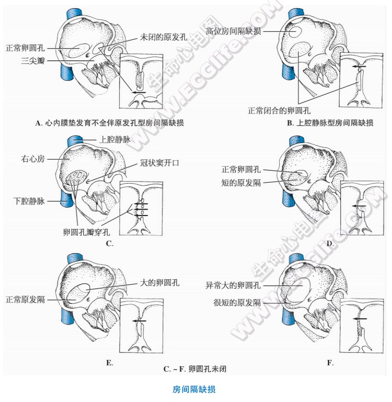 房间隔缺损的先天性畸形