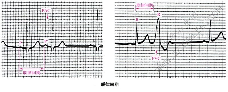 联律间期