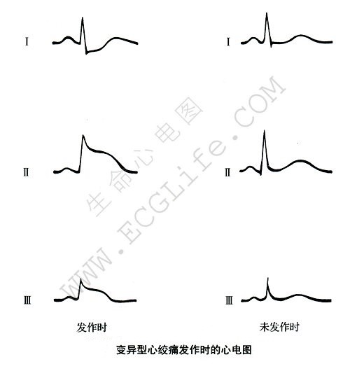 变异型心绞痛发作时的心电图