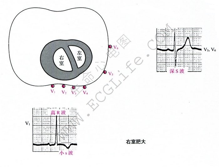 右心室肥大图解