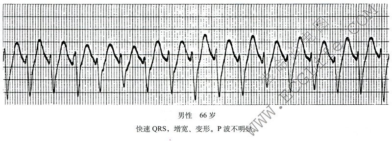 心律失常：室性心动过速心电图、快速QRS，增宽、变形。P波不明显