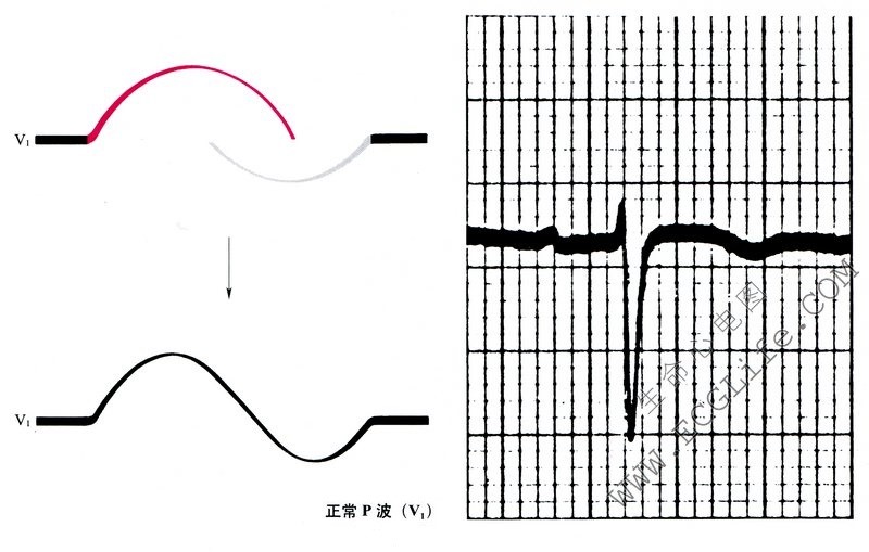 正常心电图P波