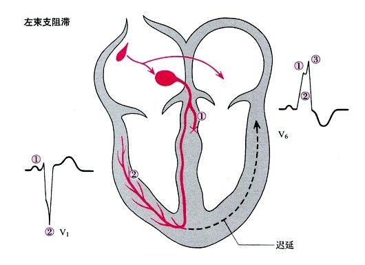 左束支阻滞与左束支分支阻滞