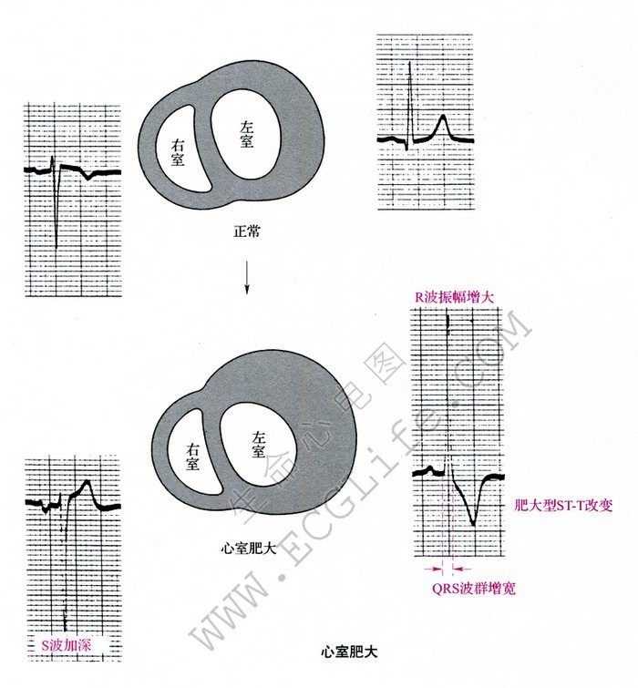 心室肥大心电图表现