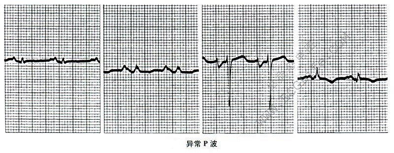 异常P波