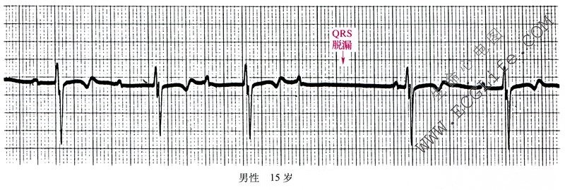 QRS脱漏