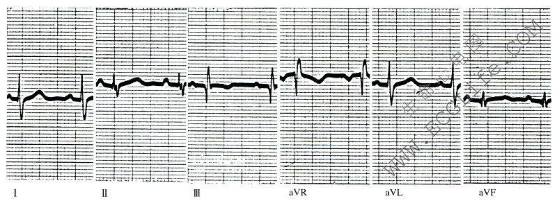 不完全性右束支阻滞心电图（导联1）