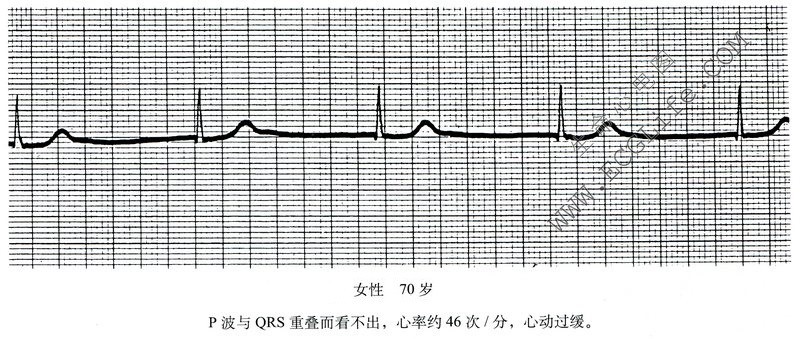 房室交界性心律心电图