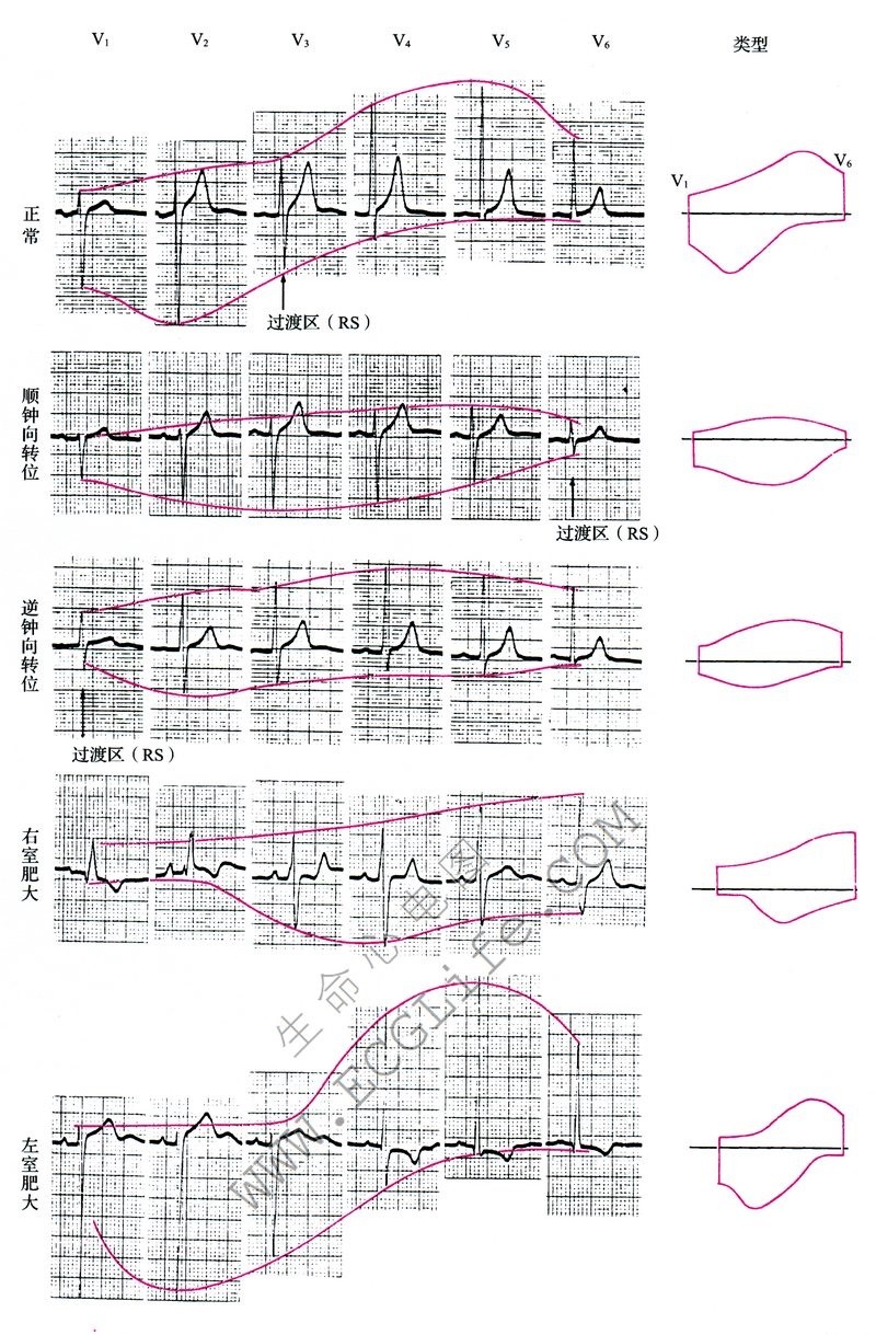 右心室肥大与左心室肥大心电图对比