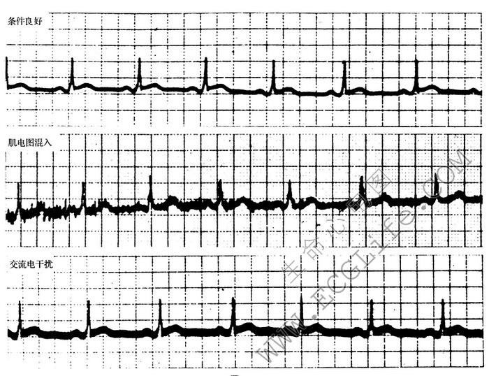 有干扰的心电图
