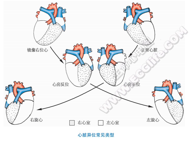 心脏异位常见类型：镜像右位心、右旋心、左旋心