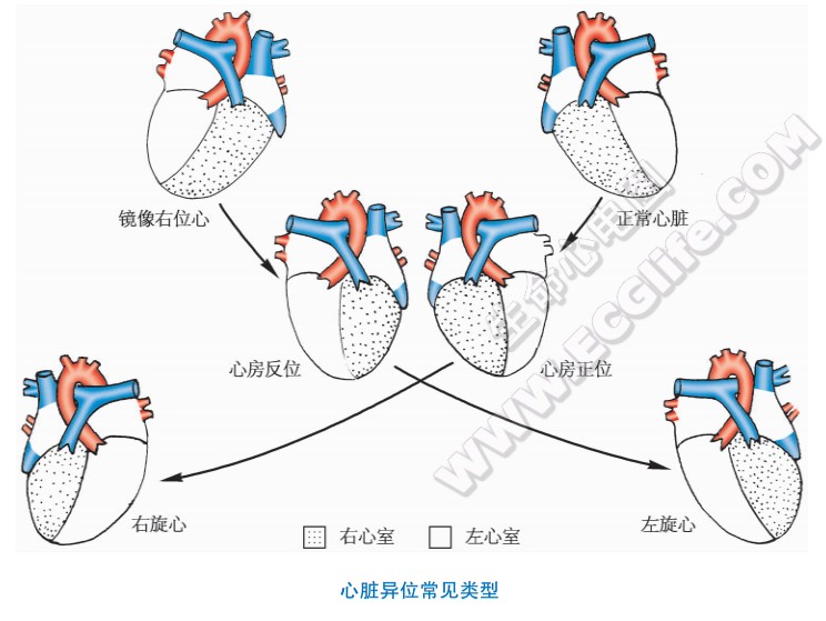 心脏异位：全心异位、心轴异位