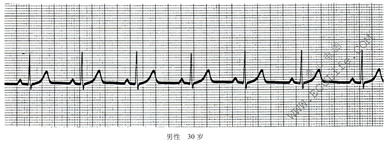 正常窦性心律的诊断依据