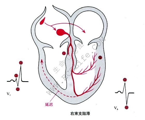 右束支阻滞（右束支传导阻滞、RBBB）