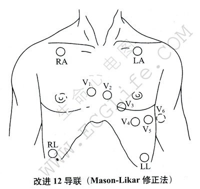 改进12导联（Mason-Likar修正法）