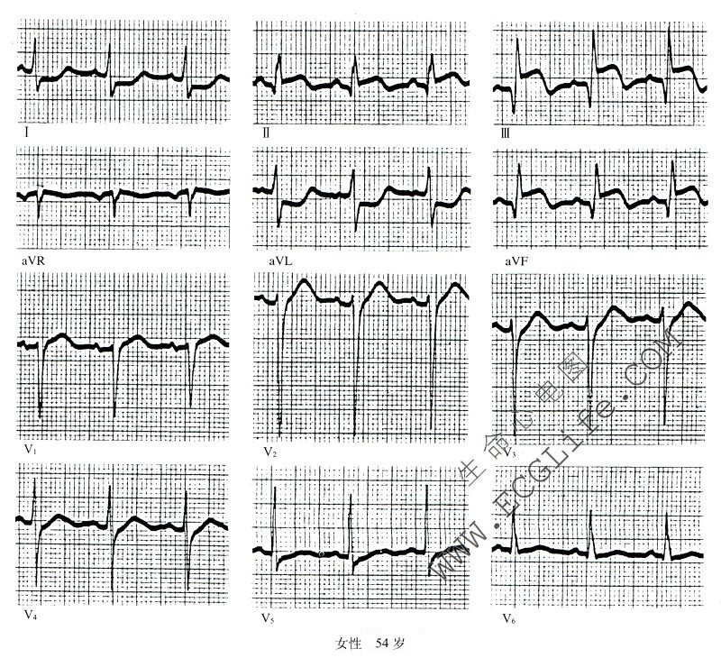 心肌梗死心电图病例