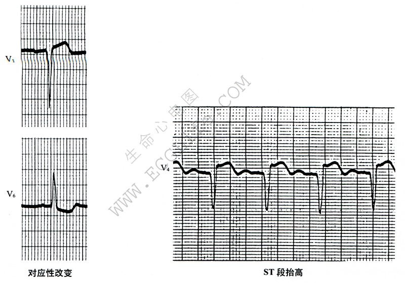 对应性改变、ST段抬高