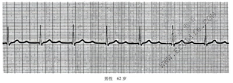 62岁男性房室传导阻滞