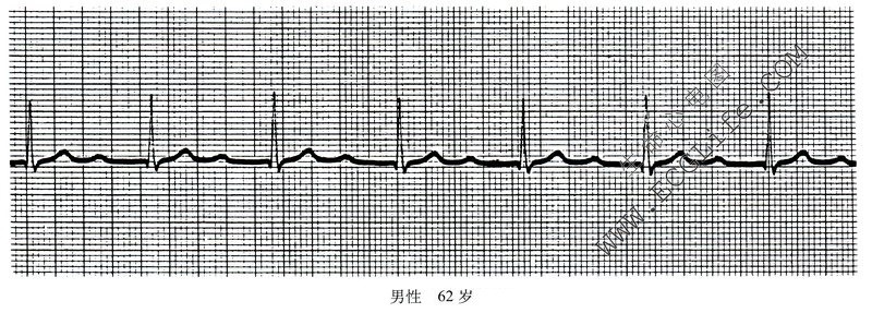 62岁男性房室传导阻滞