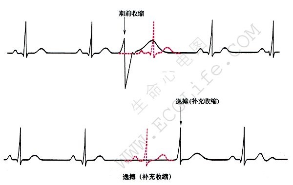 房性逸搏心电图图片