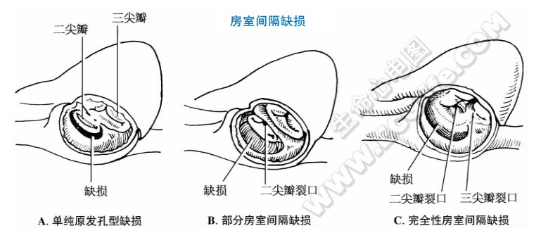 心脏房室间隔缺损示意图