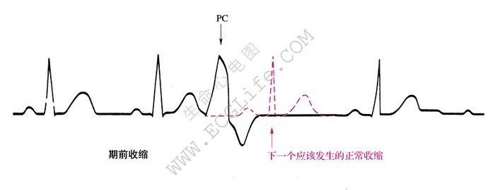 期前收缩心电图