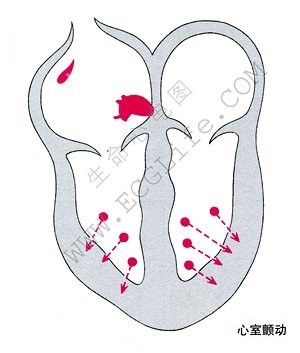 心室颤动示意图