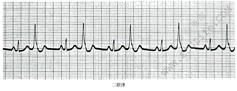 二联律期前收缩心电图