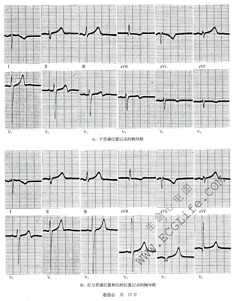 右位心心电图