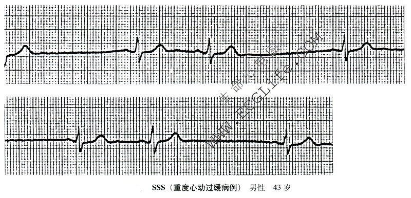 SSS（重度心动过缓病例）43岁男性（心电图）