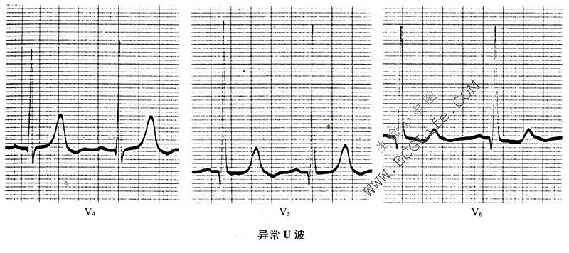 异常U波心电图