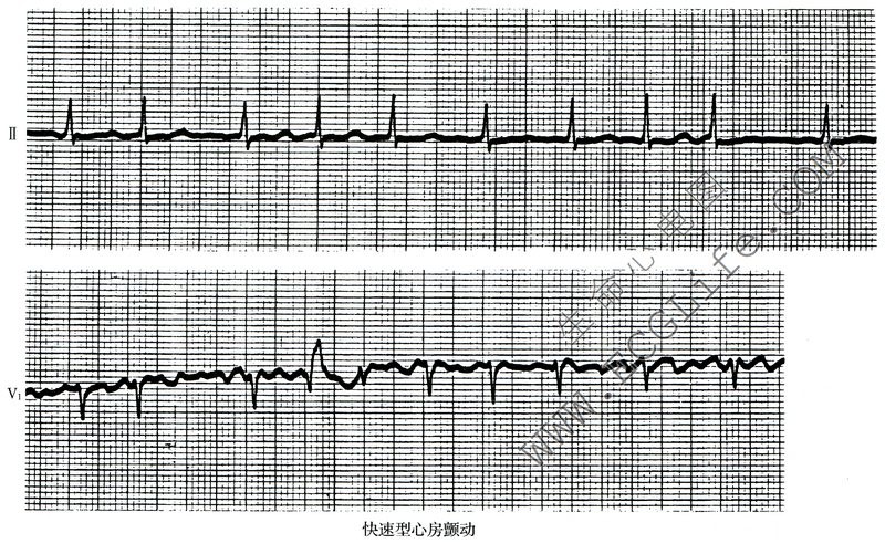 快速型心房颤动（心电图表现）