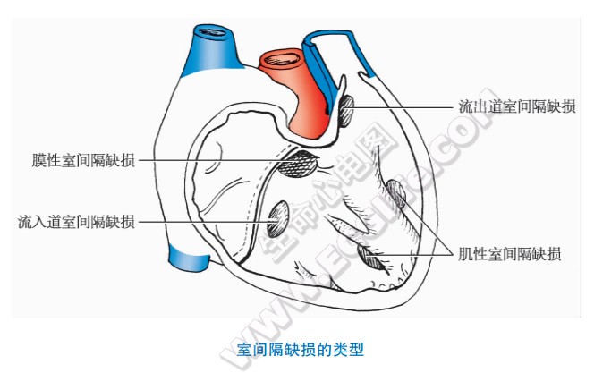 室间隔缺损的类型