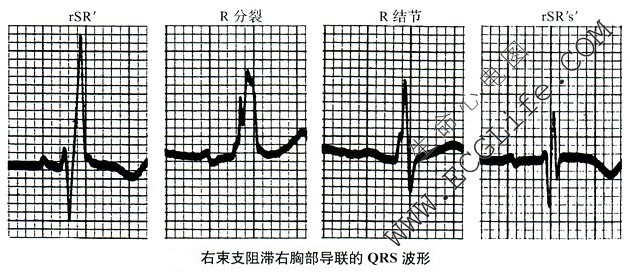 右束支阻滞右胸部导联的QRS心电波形图