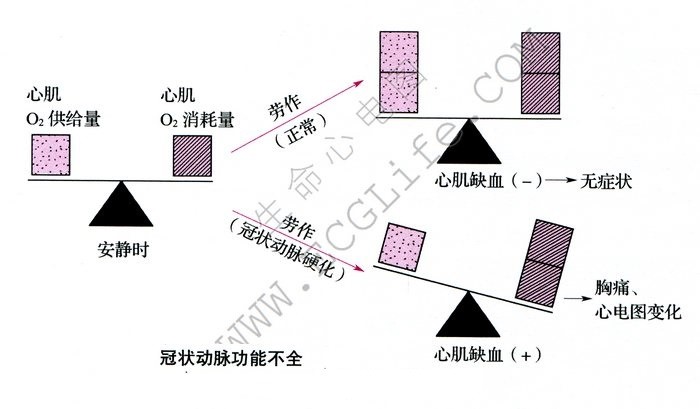 心肌缺血：冠状动脉功能不全