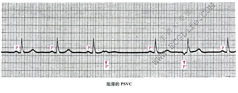 阻滞的PSVC（心电图）