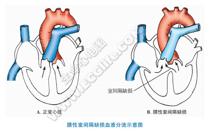 膜性室间隔缺损血液分流示意图