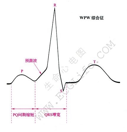 WPW综合征心电图特征表现