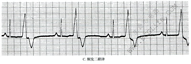 频发二联律（心电图）