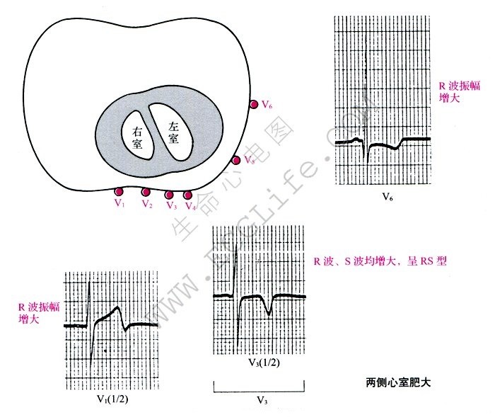 两侧心室肥大心电图解读