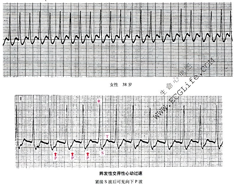 阵发性室上性心动过速